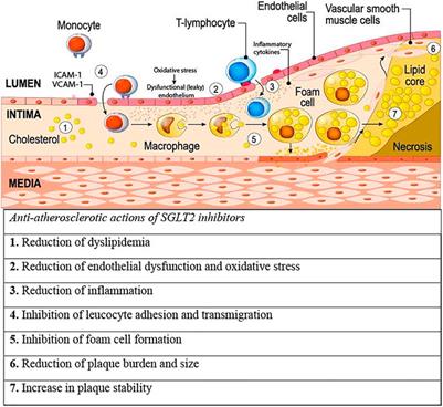 The Role of SGLT2 Inhibitors in Atherosclerosis: A Narrative Mini-Review